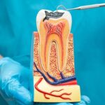 . Timely Root Canal Treatment in HSR layout can help you save your natural tooth, get rid of pain, and save the tooth from spreading infection further.